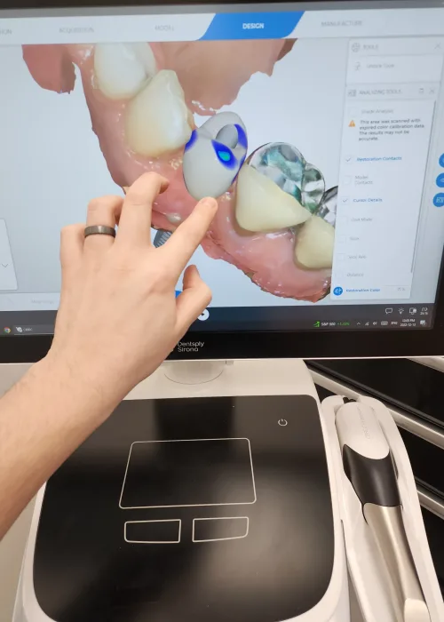  Dentist customizing a 3D digital tooth restoration model using CEREC dental design software.