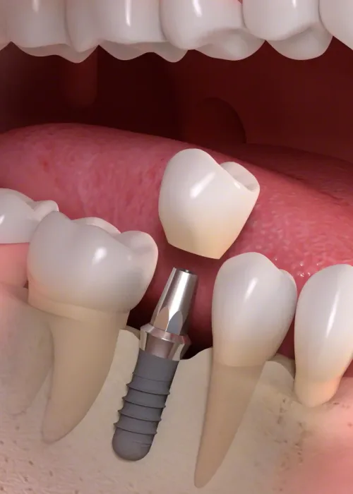 A 3D anatomical diagram illustrating how a titanium dental implant screw, abutment, and crown fit into the jaw.