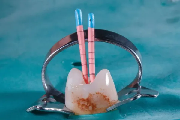 root canal painless kanata