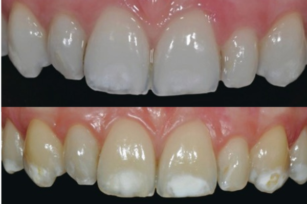 Before and after comparison photos of a patient's smile showing the dramatic aesthetic improvement after DMG Icon resin infiltration.