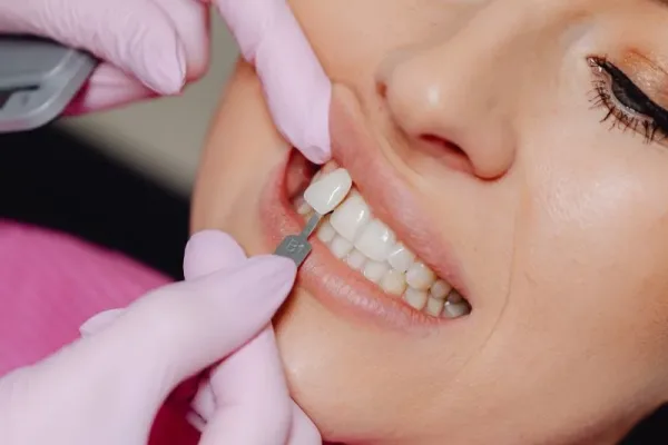A clinical examination of a patient showcasing custom porcelain veneers.