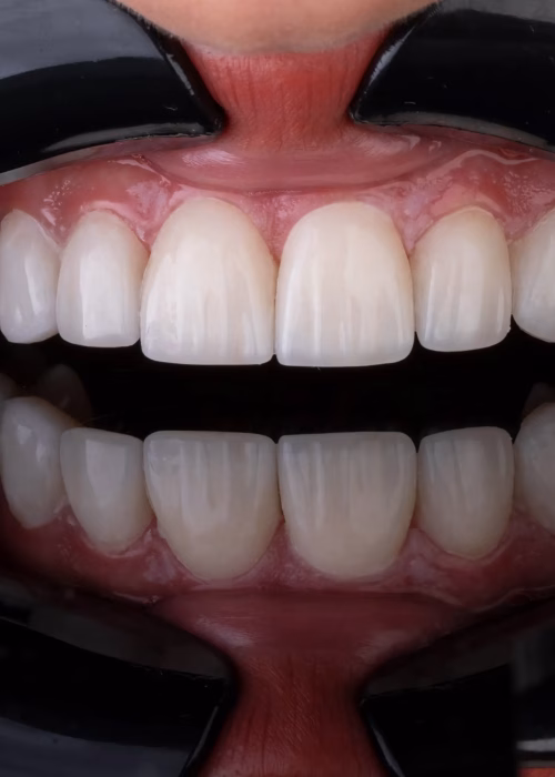 Close-up of a patient's upper teeth showcasing custom-crafted porcelain veneers.