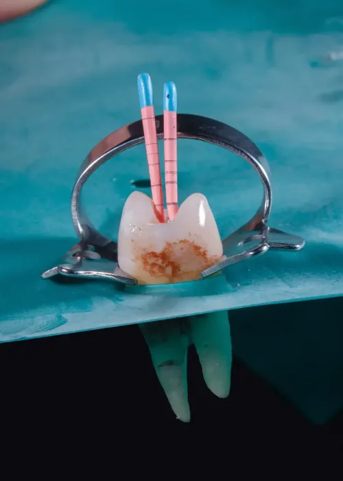 root canal painless kanata