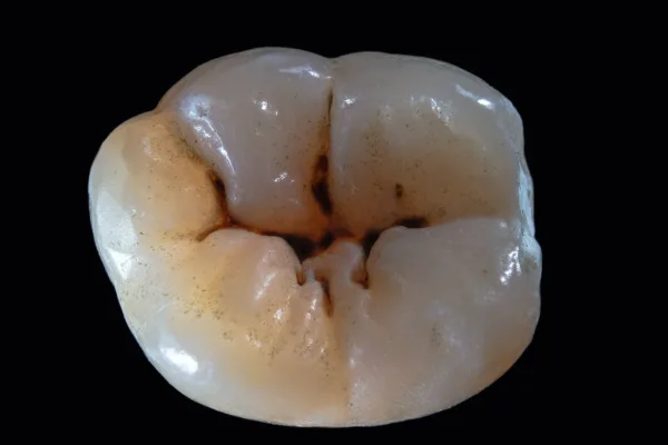 Close up of a natural looking tooth colored composite filling on a molar.