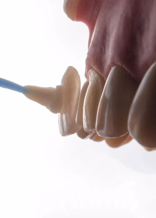 Dental professional bonding a thin, custom porcelain veneer to a prepped front tooth.